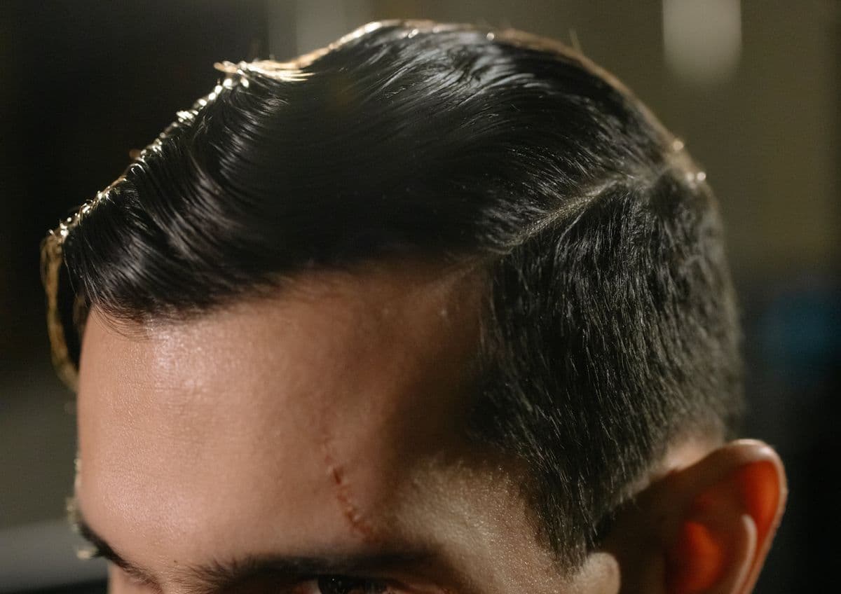 Scar Treatment: An Explainer